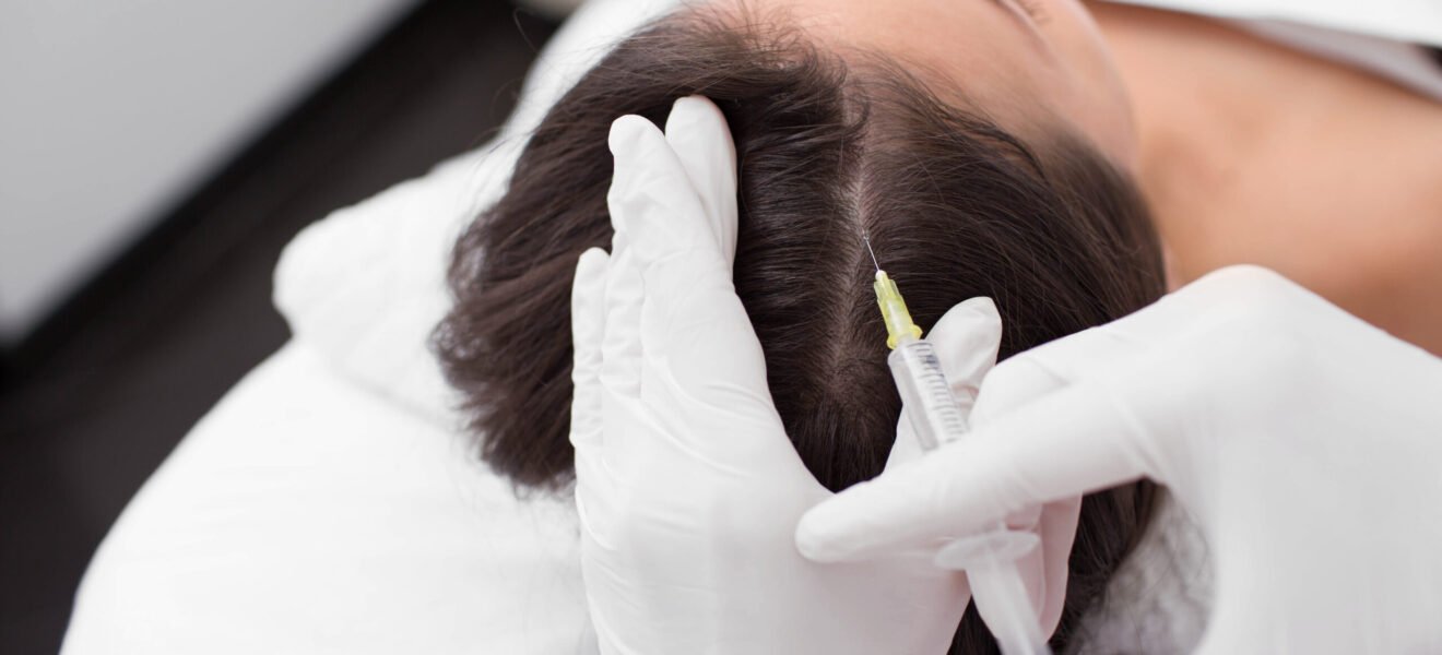treatment of hair loss, injection for hair growth. Injected in woman's head, hair mesotherapy